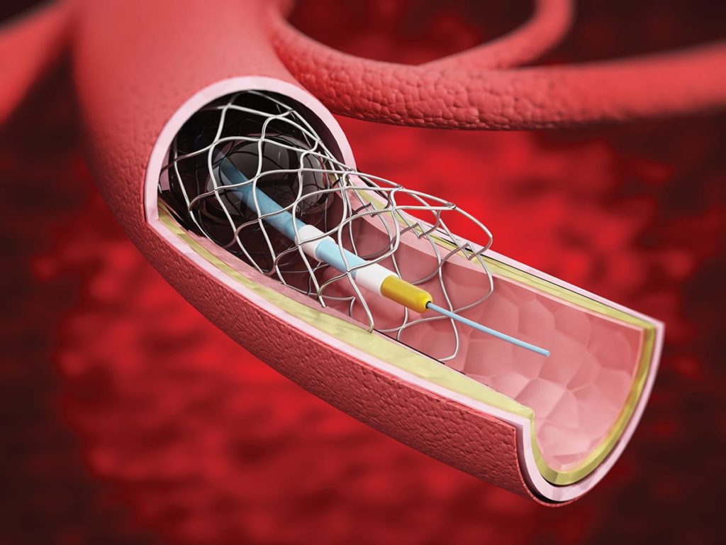 Detailed illustration showing vascular stent inside the vein.