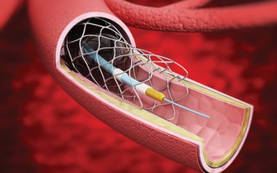 Detailed illustration showing vascular stent inside the vein.